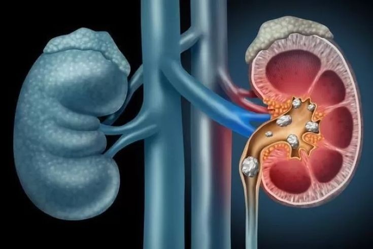 Kidney stone treatment